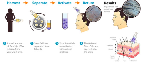 Stem Cell Method